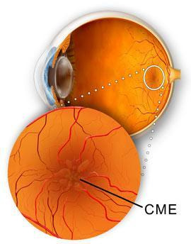 Κυστοειδές οίδημα της ωχράς κηλίδας (CME) με συγκέντρωση υγρού στην ωχρά
