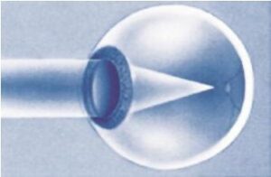 Μυωπία: πώς γίνεται το laser 
